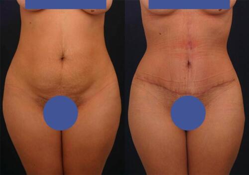 Antes/Despues