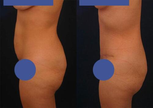 Antes/Despues