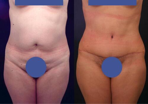 Antes/Despues