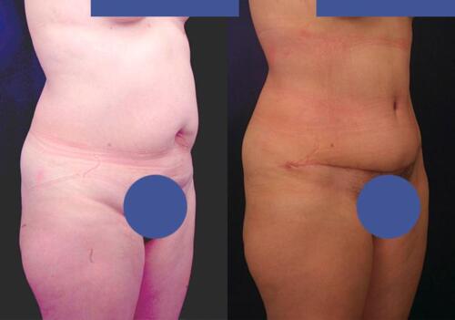 Antes/Despues