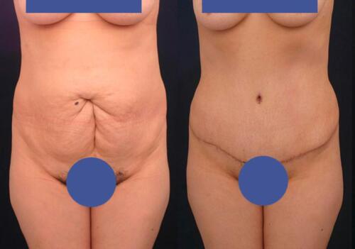 Antes/Despues