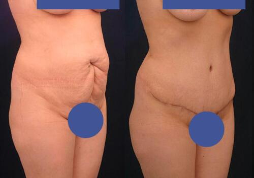 Antes/Despues