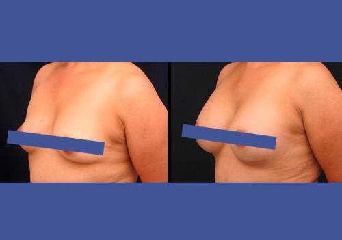 Antes/Despues