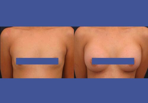 Antes/Despues