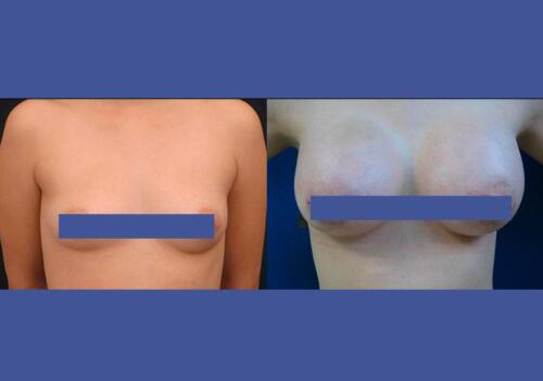 Antes/Despues