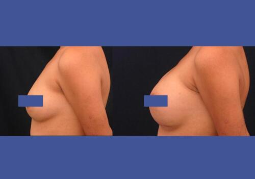 Antes/Despues