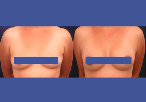 Antes/Despues
