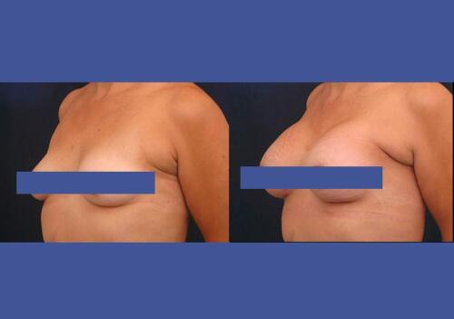 Antes/Despues