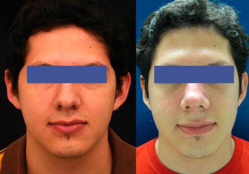 Antes/Despues