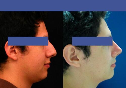 Antes/Despues
