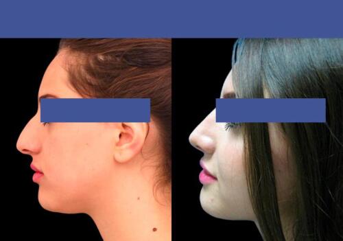 Antes/Despues