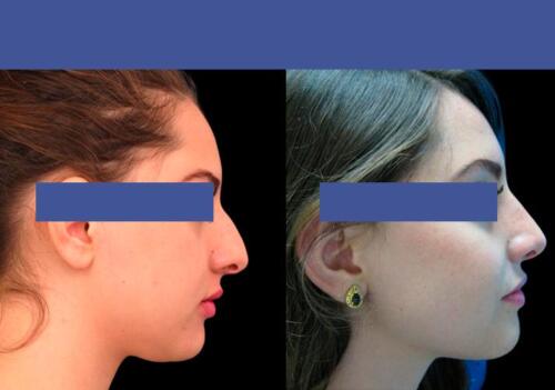 Antes/Despues