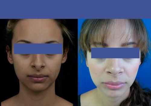Antes/Despues