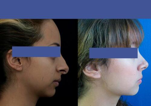 Antes/Despues